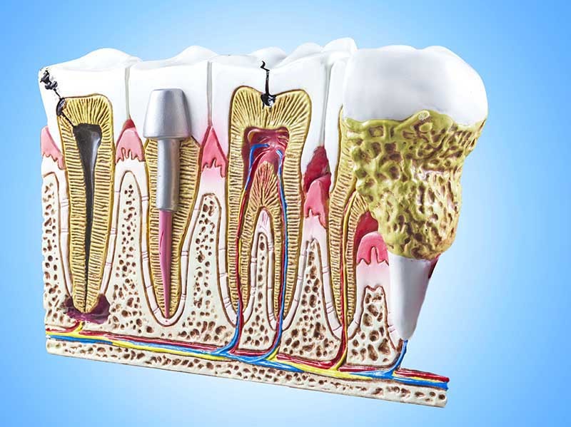 علاج جذور الاسنان- دكتور ايمن الغمراوى