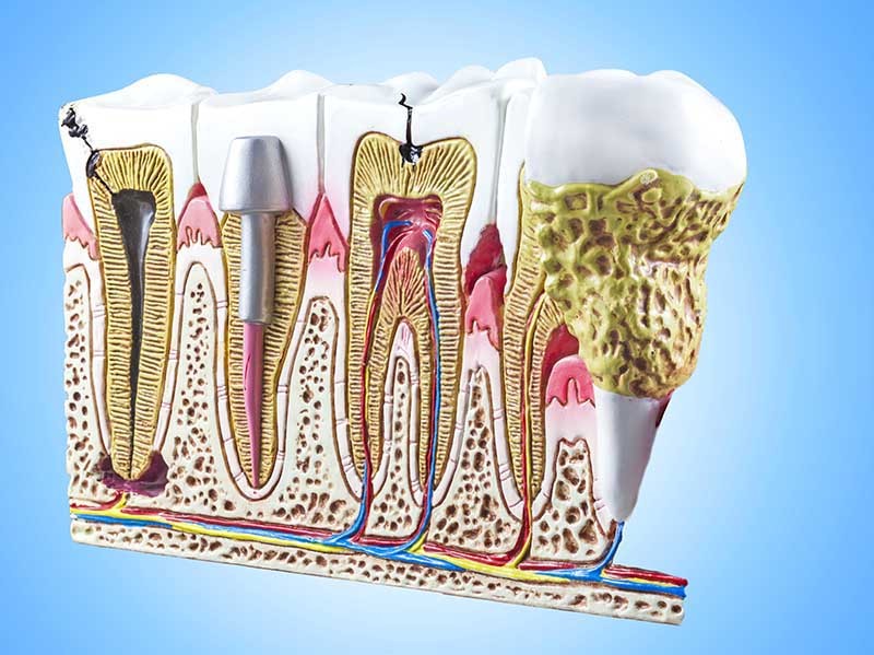 علاج جذور الاسنان