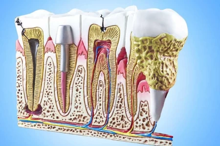 علاج جذور الاسنان