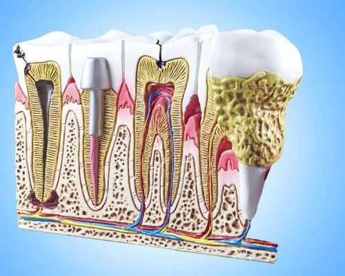 علاج جذور الاسنان